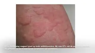 Informatieve video huidproblematiek bij COVID-19