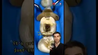 Tooth Filling - Explained