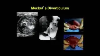 Sonographic Imaging of the Acute Pediatric Abdomen