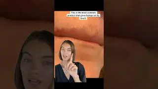 Have bumps on lip line? This is probably why🥹😳#skincare #acne #skincareforacne #acnetreatment