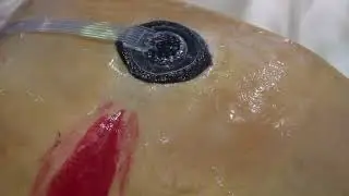 NPWT VAC Vacuum Negative Pressure wounds therapy machine