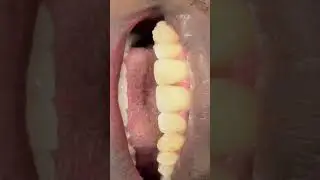 Real Adult Invisalign Before and “After” Story to Close a Front Gap. Plus, Teeth Filing!