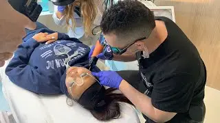 Laser Tattoo Removal for Facial Birthmark | Ruby Laser | West Hollywood, CA | Dr. Jason Emer