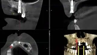 Implants into the nasal cavity