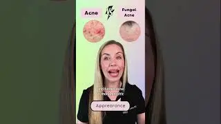 5 signs you have Fungal Acne, NOT regular acne!🙈