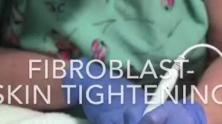 Fibroblast Therapy