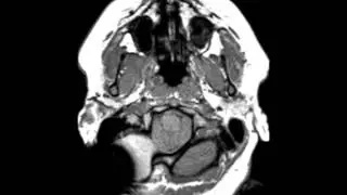 Chiari II Malformation