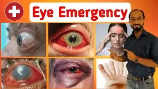 What is an eye emergency | Traumatic Eye Injury | Foreign body, chemecal burn | Red Eyes | Diplopia