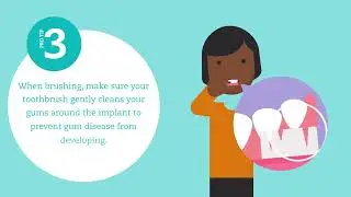 How to care for your dental implants