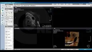 How to Reslice the  CBCT Case
