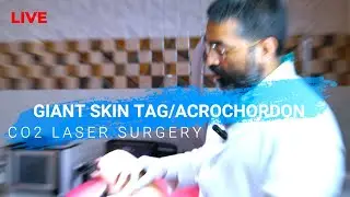 GIANT SKIN TAG REMOVAL #co2laser  #lasersurgery #scarlesssurgery  #skincare #skintag  #video