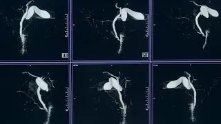 MRCP 3D MRI 