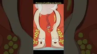 process of pulling out Ascaris