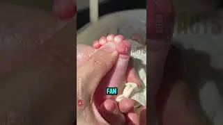 This Toe Reflex Can Reveal Brain Damage