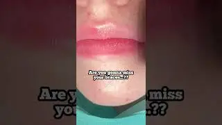 Before and After Braces Treatment- Braces off -  Are you going to miss your braces? - Toothtime