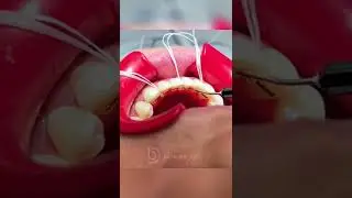 Bonding a fixed or &ldquo;permanent&rdquo; retainer - w/ The Braces Doc