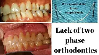 Lack of two phase orthodontics