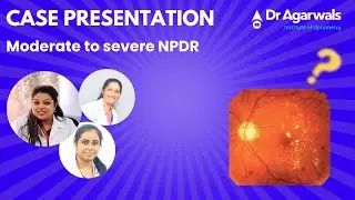 Case Presentation: Moderate to severe NPDR