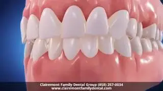 Invisalign Dentist San Diego CA