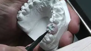Davide Spaiardi Art Oral ZR stratificazione molare