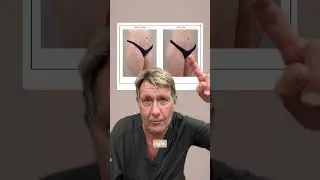 BBL and Hip Dip Fat Transfer