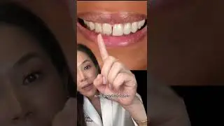 The truth about no prep veneers. Part 1 #veneer #veneers #dentist #smilemakeover #newsmile