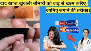 Ring guard cream uses in hindi ( लगाने का सही तरीका जानें) | Ring guard cream |review in hindi