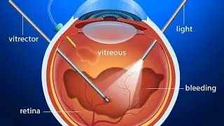 VITREOUS HEMORRHAGE AND INDICATIONS OF PARS PLANA VITRECTOMY| OPHTHALMOLOGY