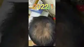 ハゲの薬 半年試した結果デュタステリド