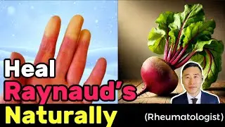 Must-Know Tips to Heal Raynaud&rsquo;s Naturally from an Integrative Rheumatologist