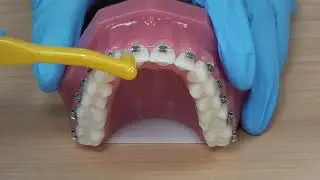 Using a single tufted brush with fixed braces.