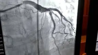 Stent Correction of 100% Blockage of the Left Anterior Descending Artery