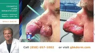 San Diego Dermatology Expert Dr. Groff Discusses Skin Condition called Rhinophyma