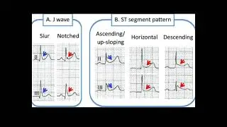 High risk features of Benign early repolarization pattern on ECG