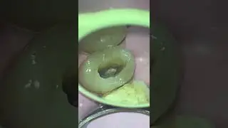Live Demo for Fiber post Removal || Dr.Muhannad Takruri