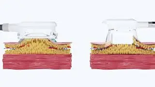 NUBWAY 360 cryolipolysis machine introduction video
