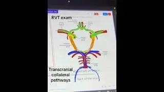 Transcranial Doppler 