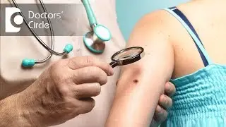 How to manage Melanocytic Neoplasms? - Dr. Rasya Dixit