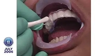 Dr. Robert Ibsen Presents Jay R., a Lumineers&reg; Clinical Case Presentation: 2006