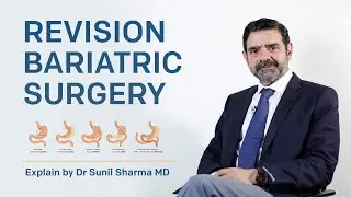 Revision Bariatric Surgery Explained By Dr Sunil Sharma