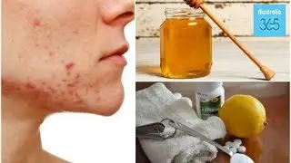 6 Natural Remedies for Cystic Acne - Australia 365