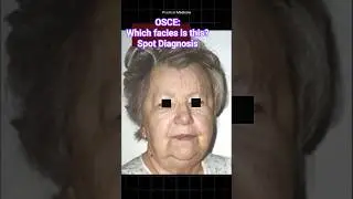 Weight gain and lethargy - What is this facies? #OSCE #spotdiagnosis #diagnosis #facies