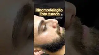 Rinomodela&ccedil;&atilde;o Definitiva - Redu&ccedil;&atilde;o de Giba