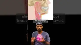 Genioplasty (Chin Surgery) as a Treatment to Sleep Apnea? #sleepapnea #sleepdisorder #shorts
