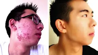 HOW TO COVER UP ACNE | FULL COVERAGE ROUTINE | MENS MAKEUP
