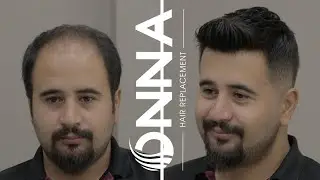 PROTEZ SA&Ccedil; - Hair Replacement