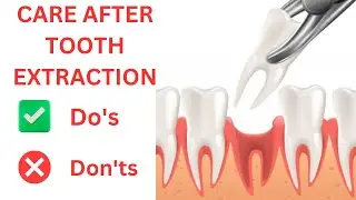 How to Care After Tooth Extraction: Essential Recovery Tips
