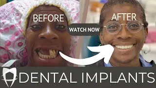 Dental Implants: A Comprehensive Guide to Permanent Tooth Replacement