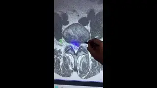 How spinal decompression relieved real disc herniation & burning calf pain&mdash;no surgery