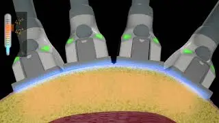 Cynosure SculpSure MOA 1080p 2017